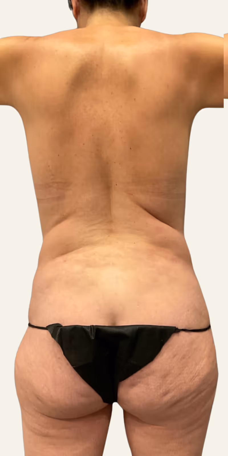 BBL Case 9 before view