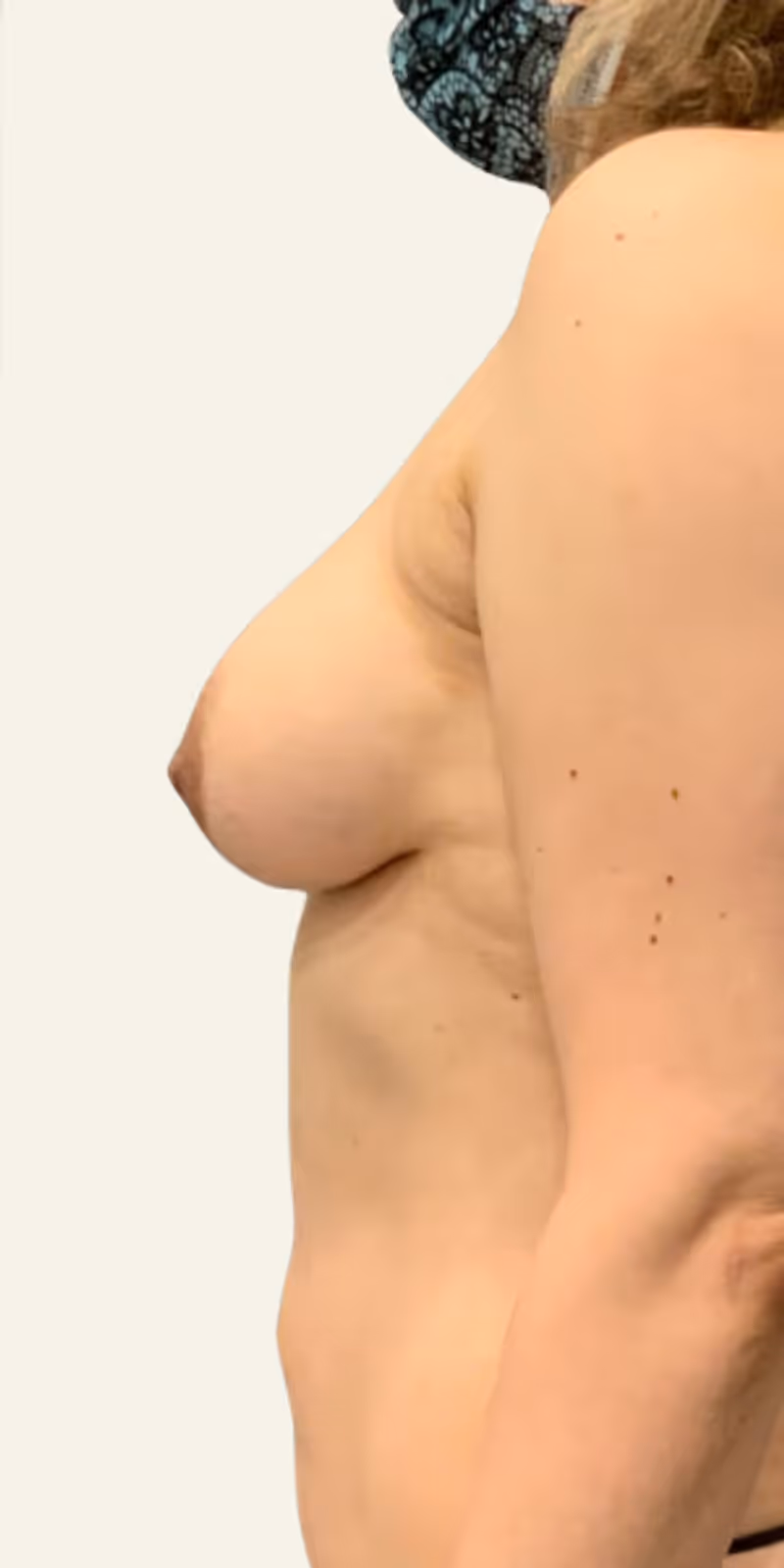 Breast Fat Grafting Case 1 after view