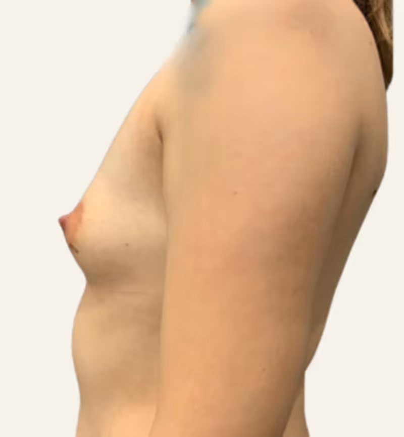 Breast Fat Grafting Case 10 before view