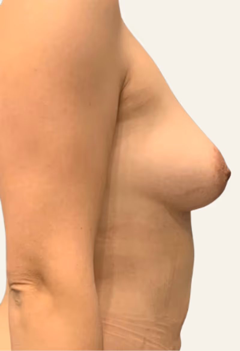 Breast Fat Grafting Case 13 after view