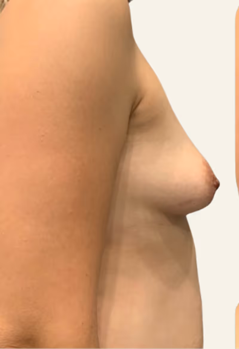 Breast Fat Grafting Case 13 before view
