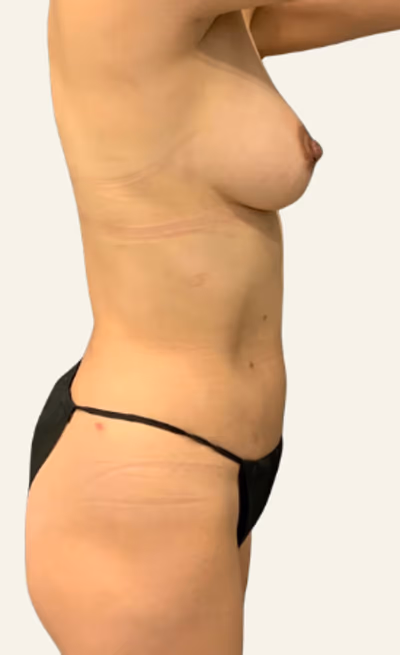 Breast Fat Grafting Case 14 after view