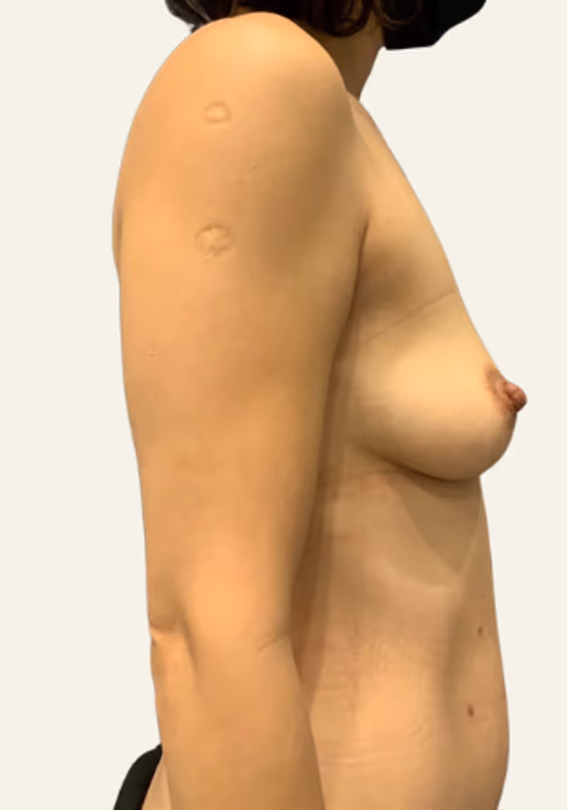 Breast Fat Grafting Case 15 before view