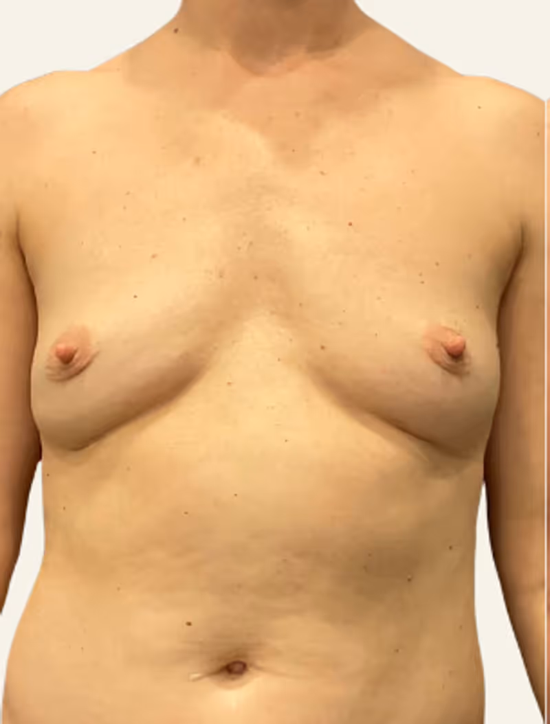 Breast Fat Grafting Case 17 before view