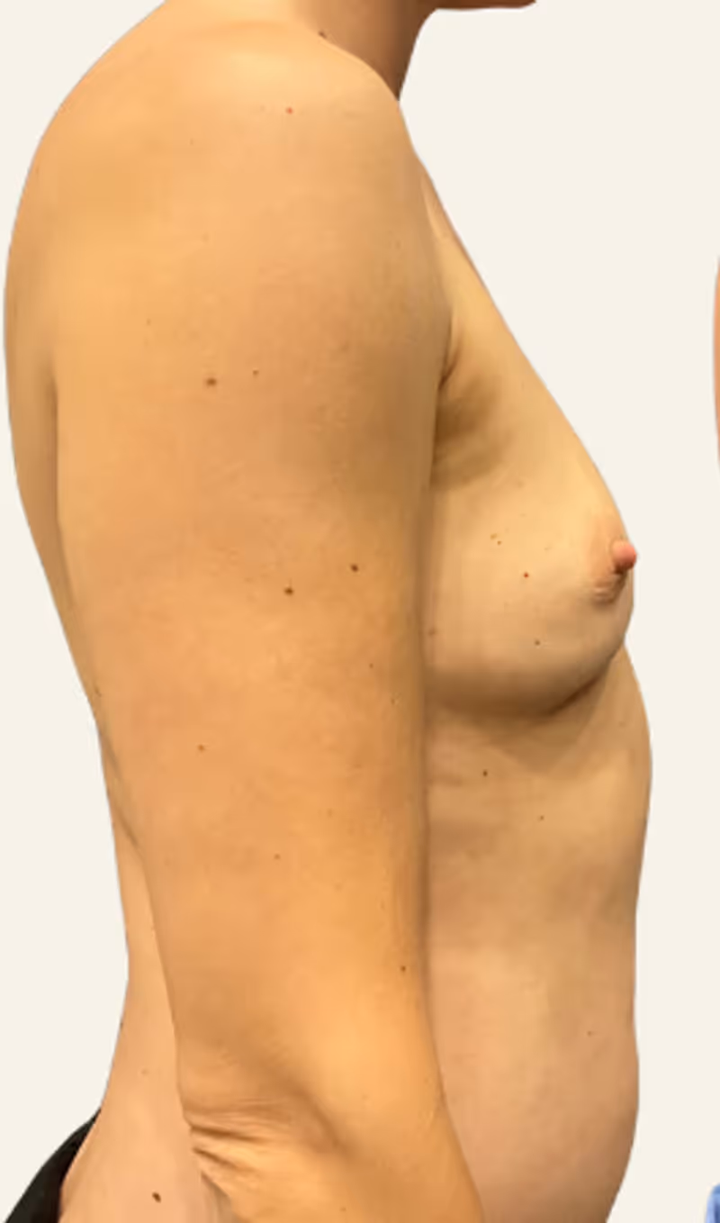 Breast Fat Grafting Case 18 before view