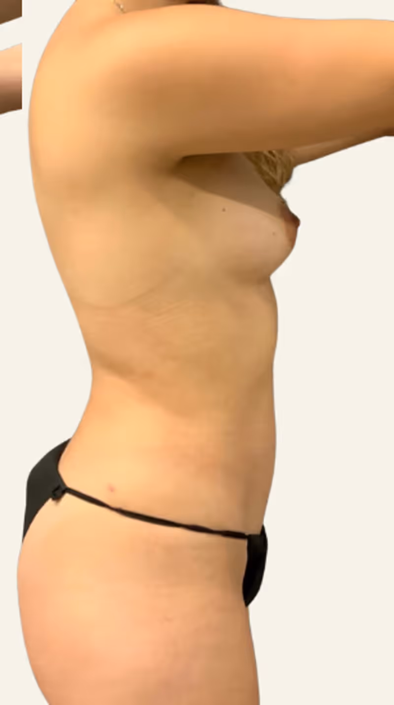 Breast Fat Grafting Case 20 after view