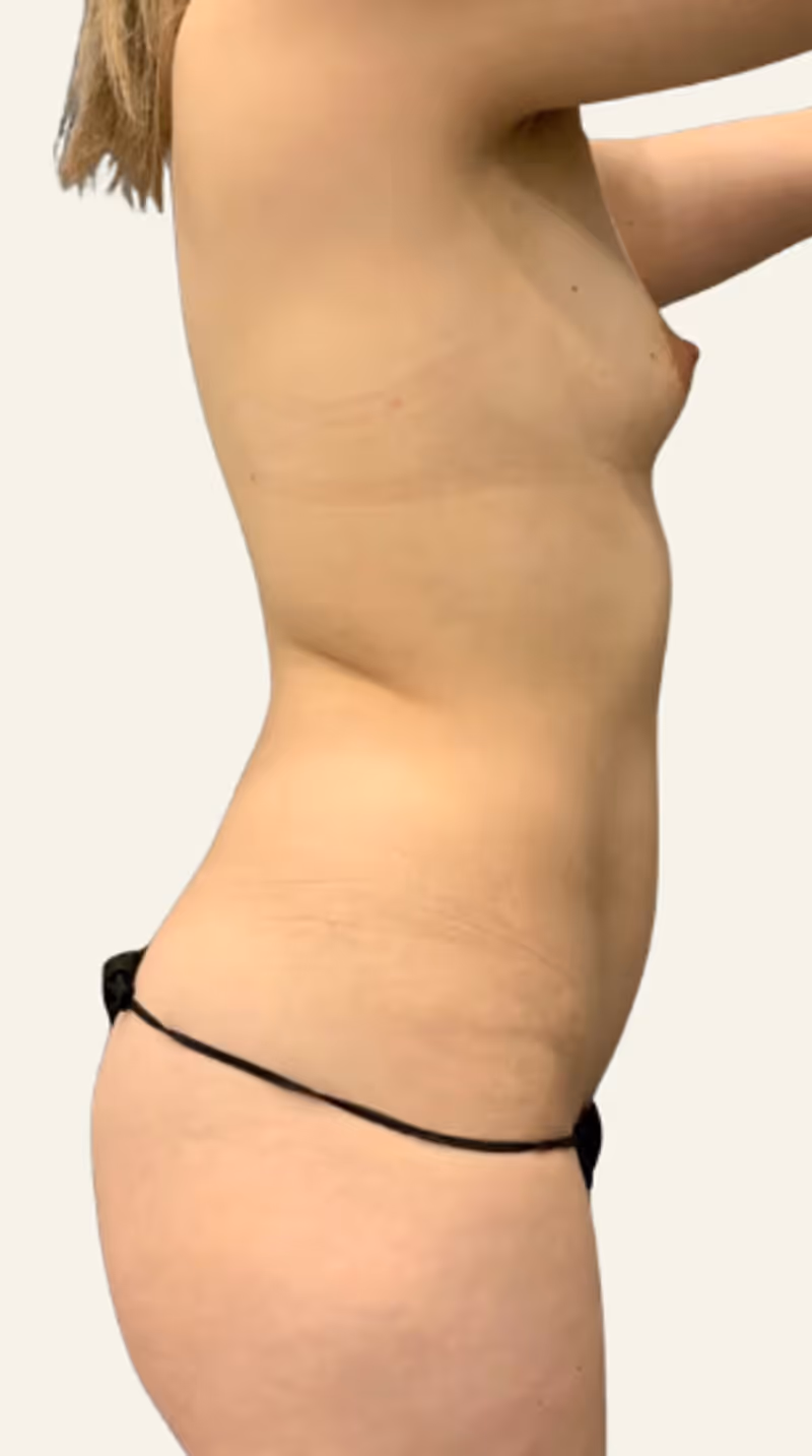 Breast Fat Grafting Case 20 before view