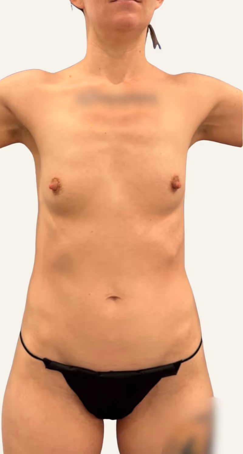 Breast Fat Grafting Case 21 before view