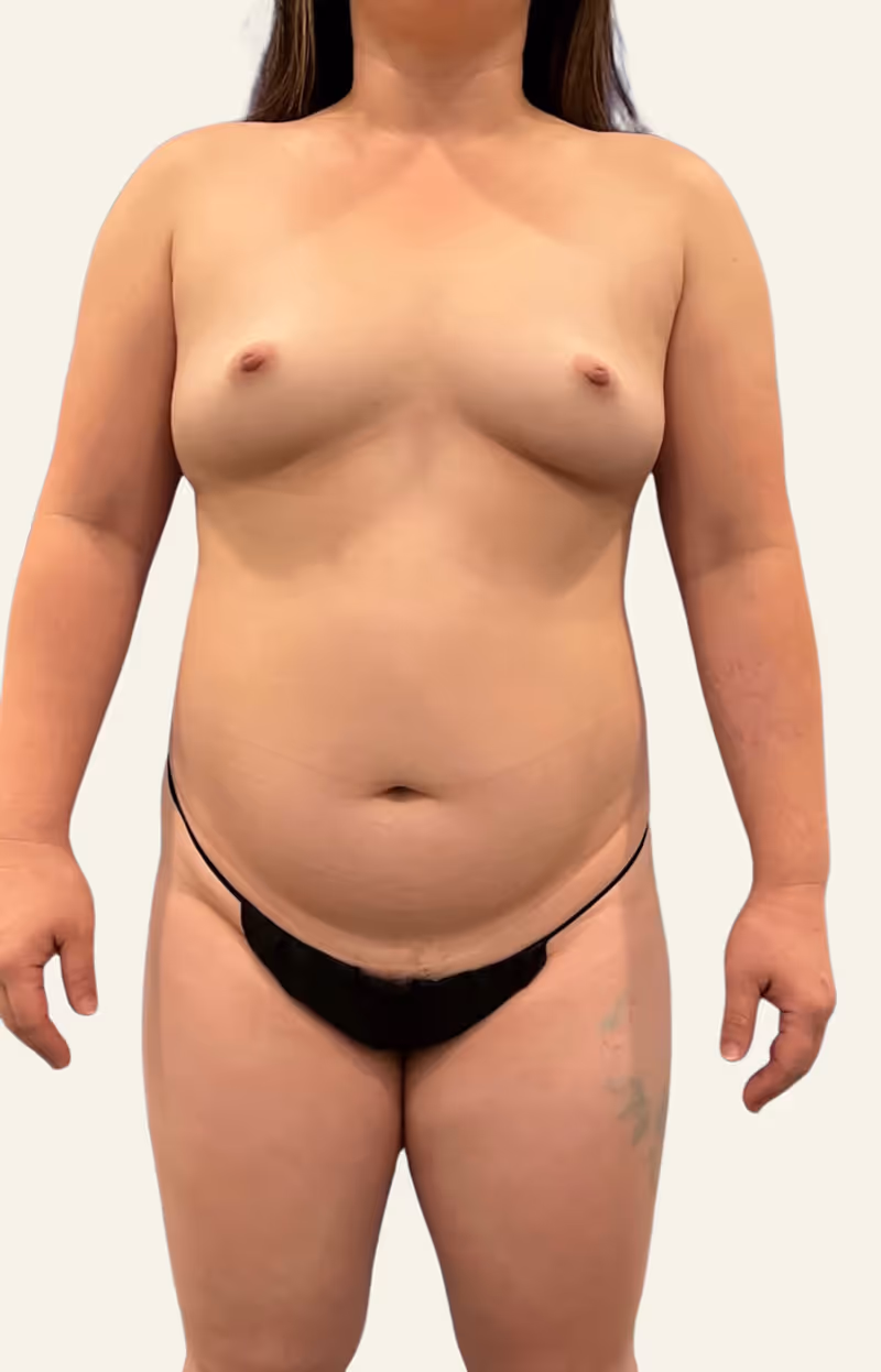 Breast Fat Grafting Case 22 before view