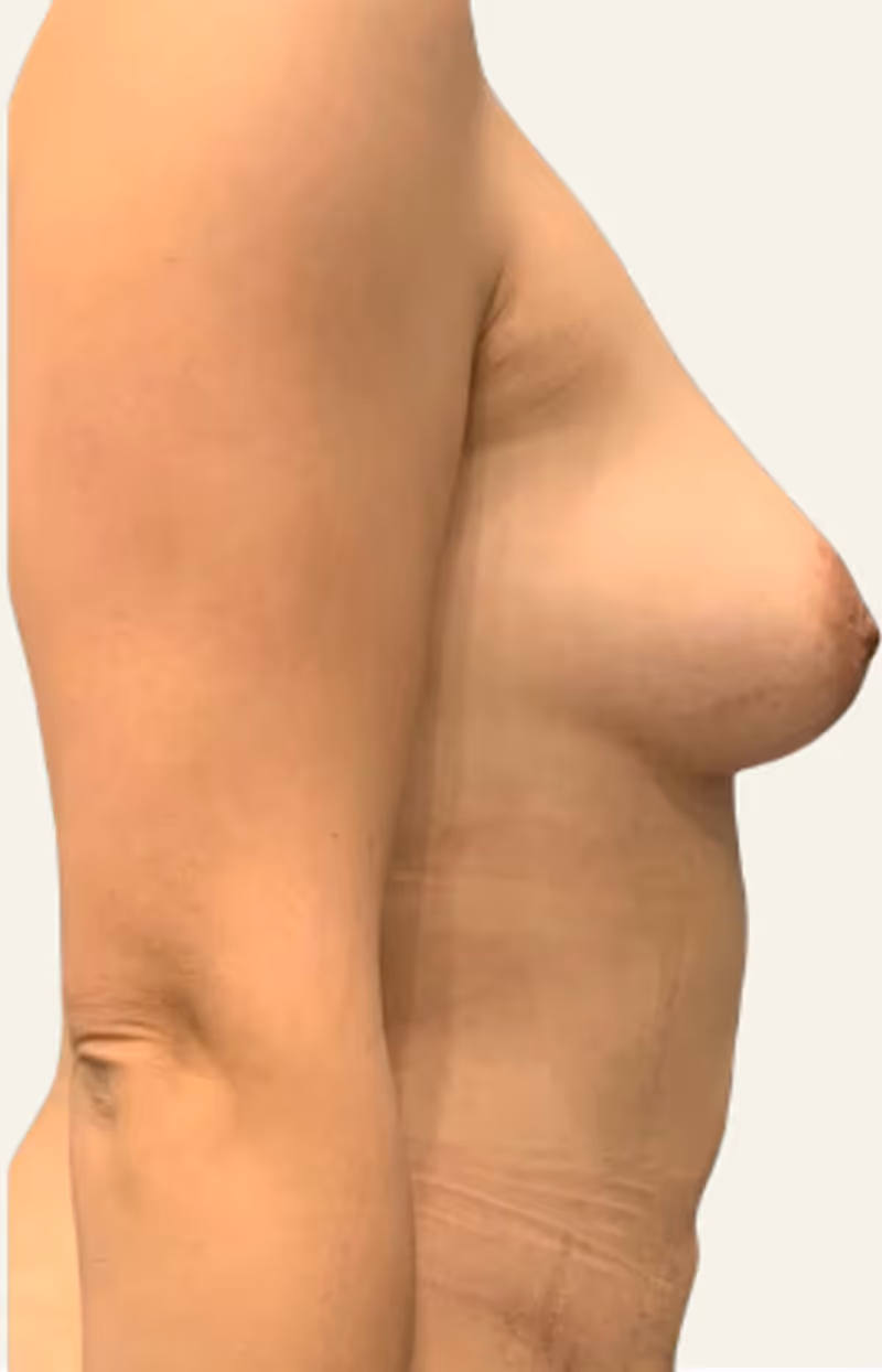 Breast Fat Grafting Case 3 after view