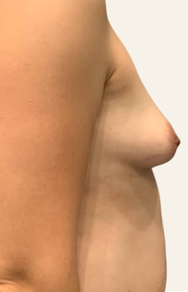Breast Fat Grafting Case 3 before view
