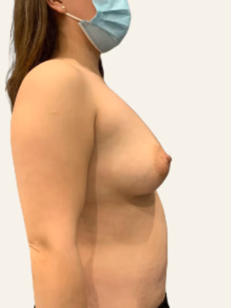 Breast Fat Grafting Case 4 after view