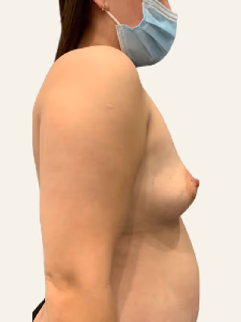 Breast Fat Grafting Case 4 before view