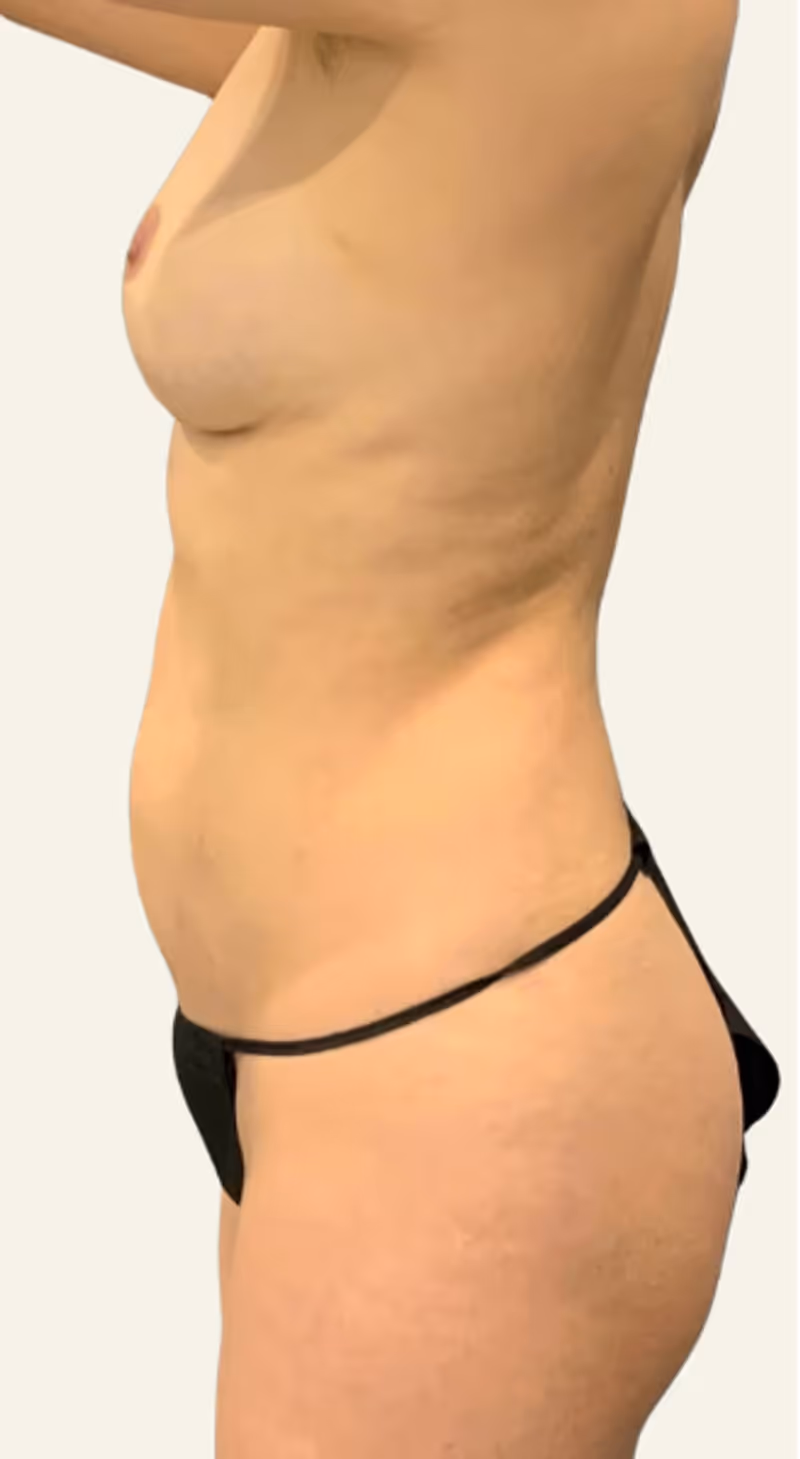 Breast Fat Grafting Case 7 after view