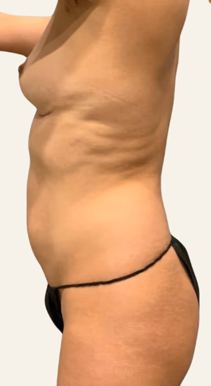 Breast Fat Grafting Case 7 before view