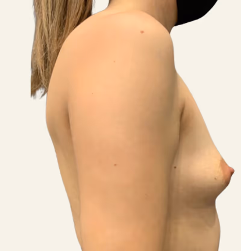 Breast Fat Grafting Case 9 before view