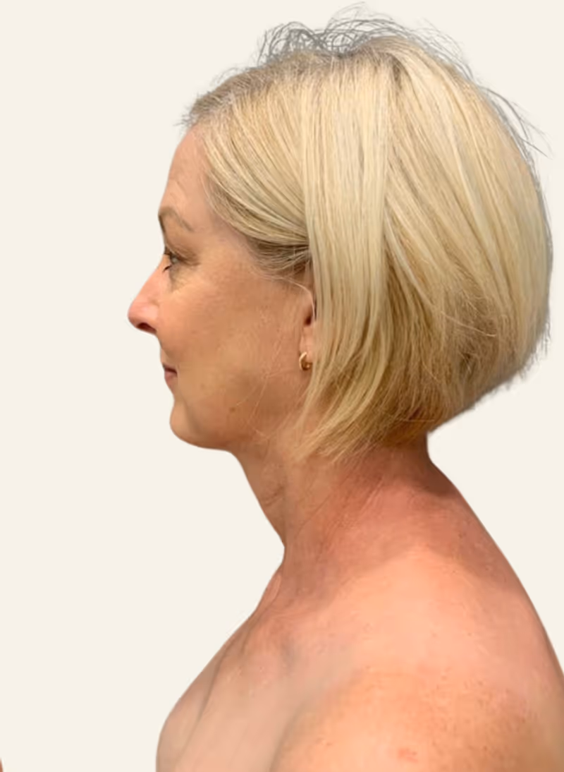 Chin Liposuction Case 1 after view