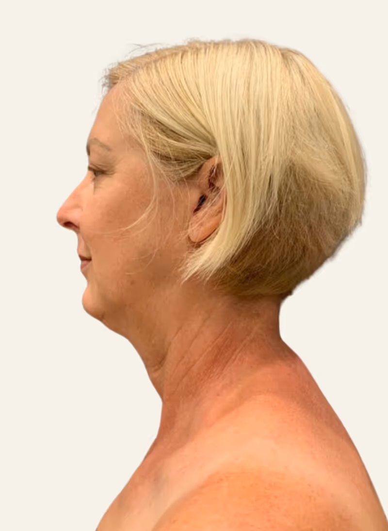 Chin Liposuction Case 1 before view