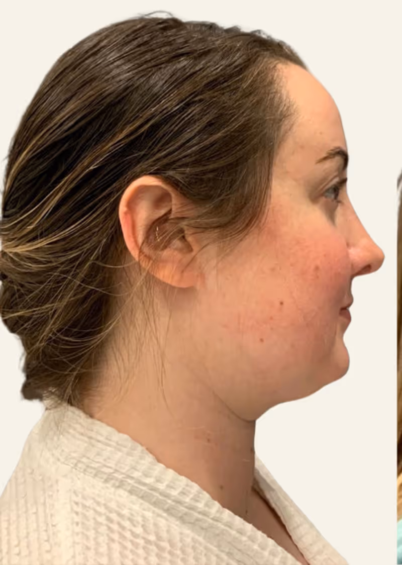 Chin Liposuction Case 2 before view