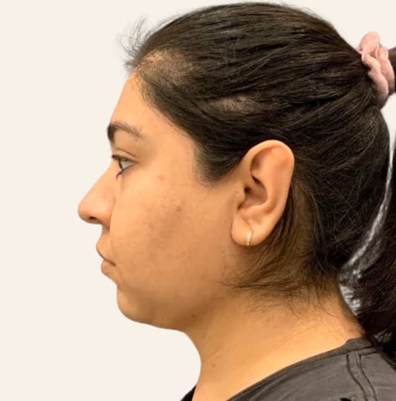Chin Liposuction Case 5 after view