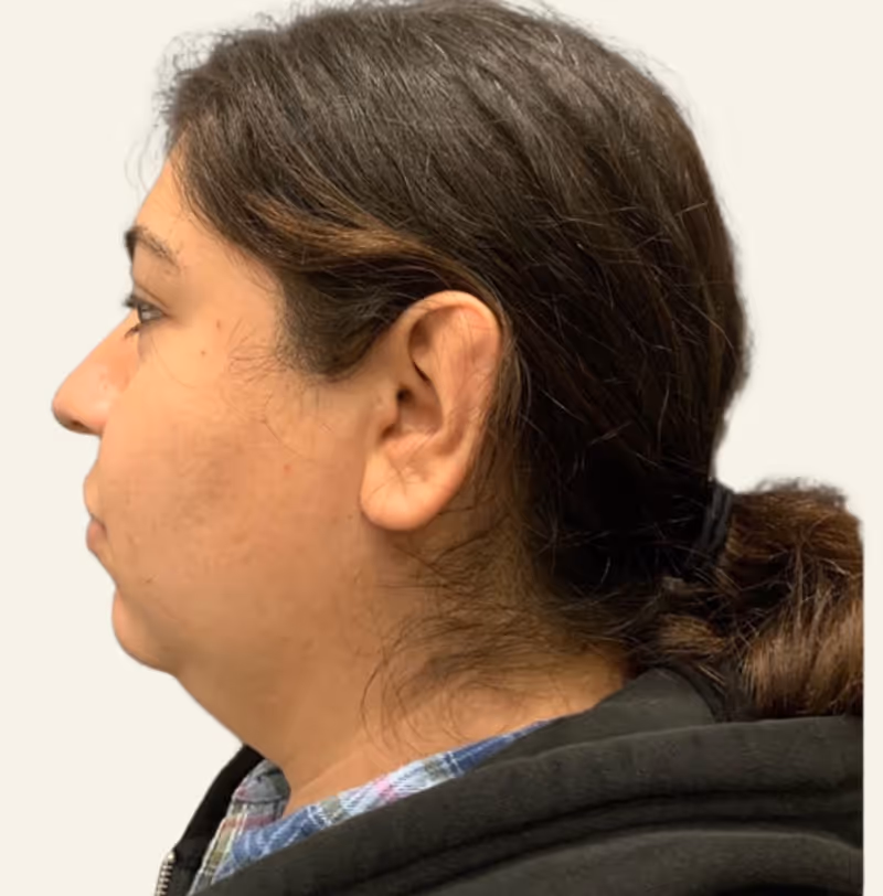 Chin Liposuction Case 5 before view