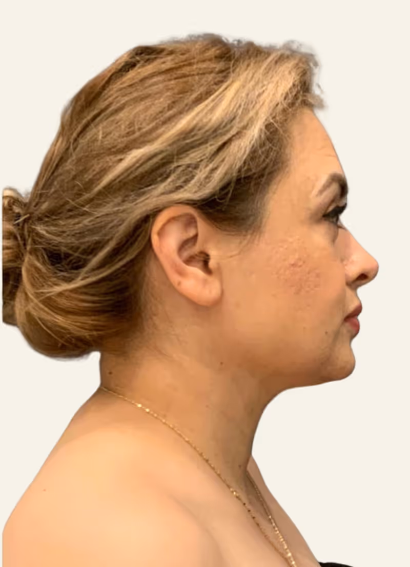 Chin Liposuction Case 6 after view