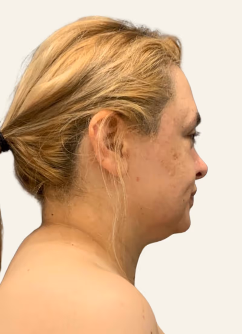 Chin Liposuction Case 6 before view