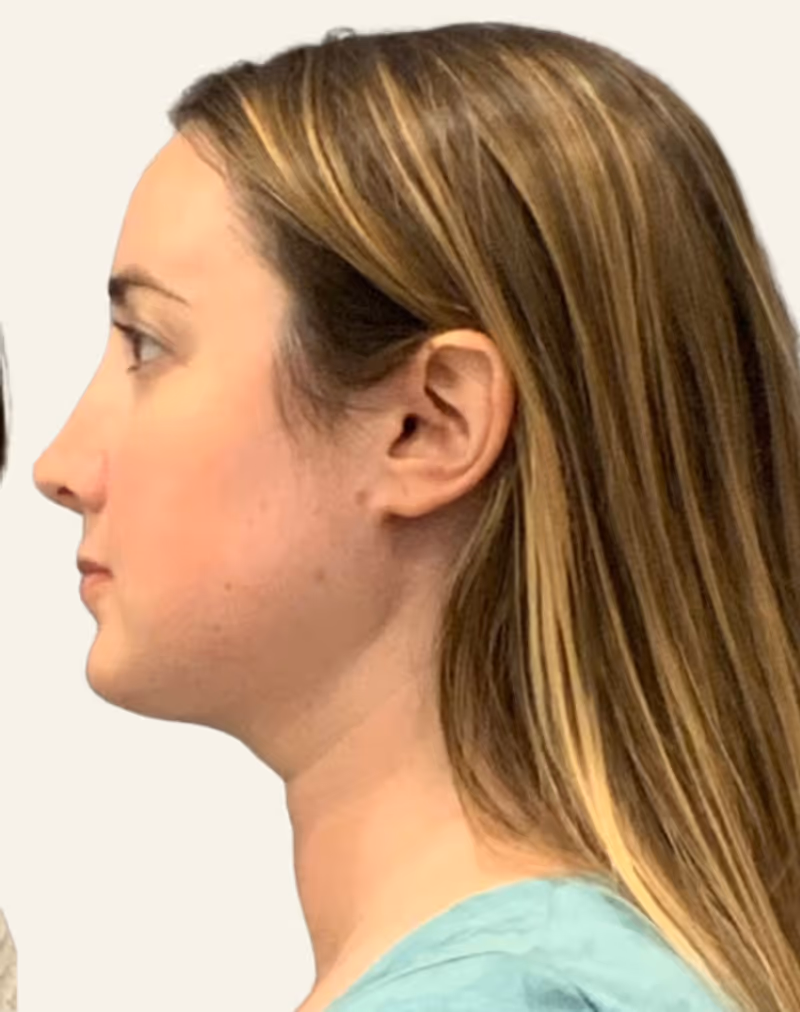Chin Liposuction Case 7 after view