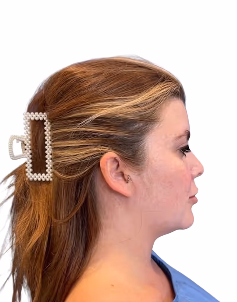 Chin Liposuction Case 8 before view