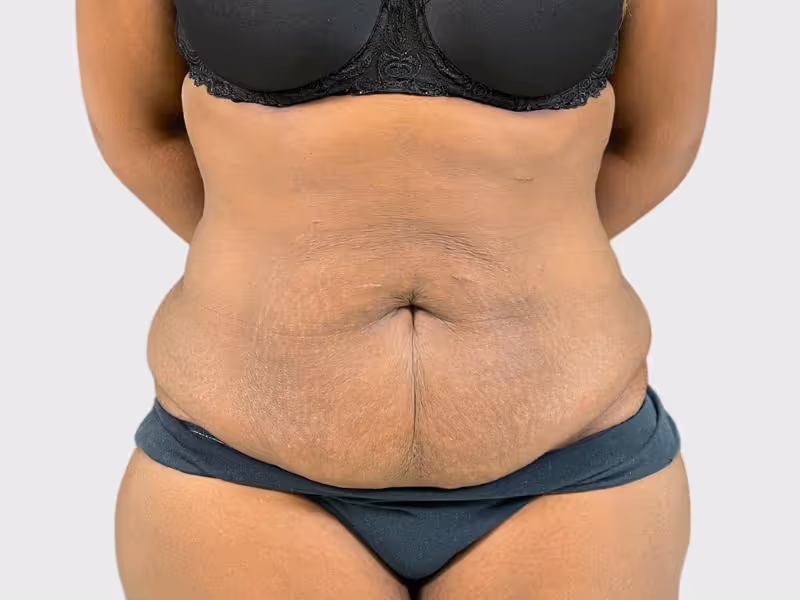Abdominoplasty Case 4 before view
