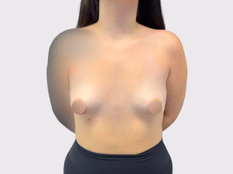 Breast Lift Case 2 before view