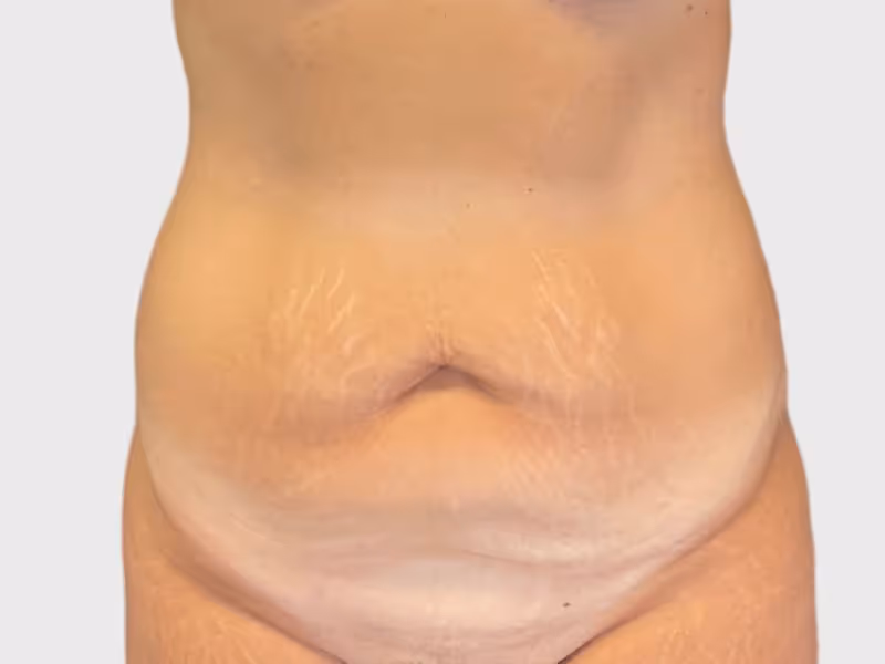 Abdominoplasty Case 3 before view