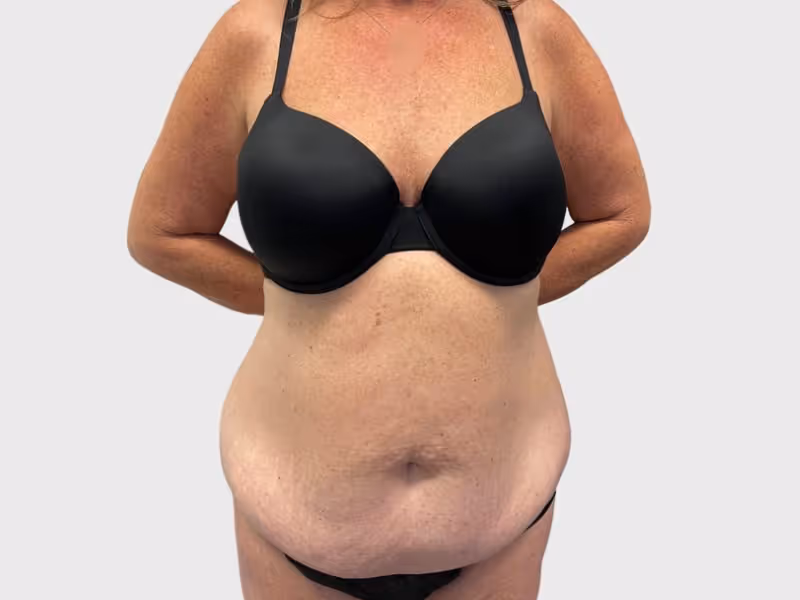 Abdominoplasty Case 7 before view