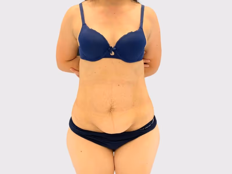 Abdominoplasty Case 1 before view