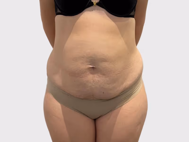 Abdominoplasty Case 6 before view