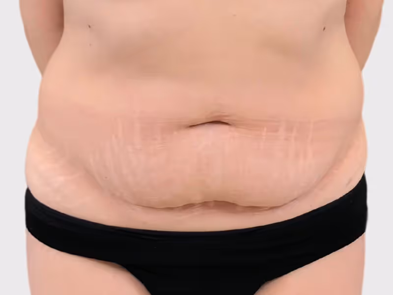 Abdominoplasty Case 2 before view