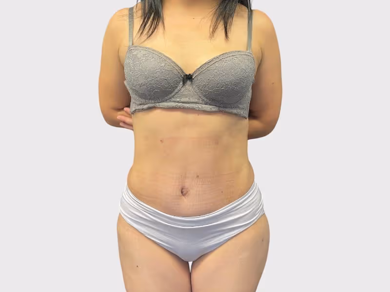 Abdominoplasty Case 1 after view