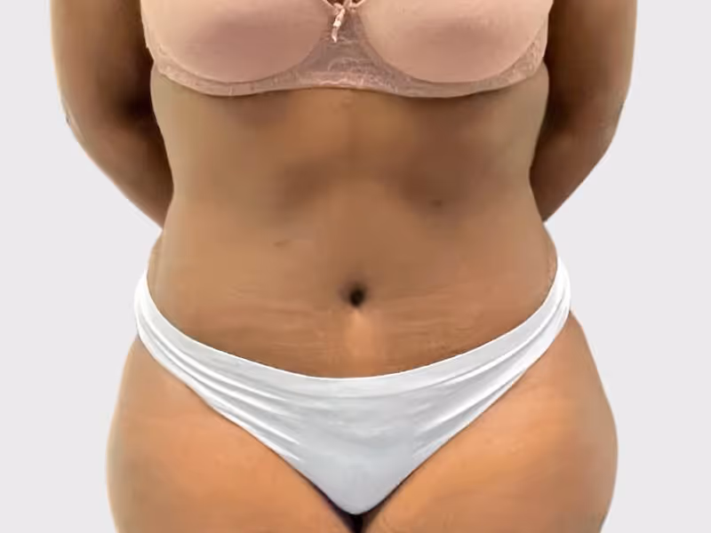 Abdominoplasty Case 4 after view