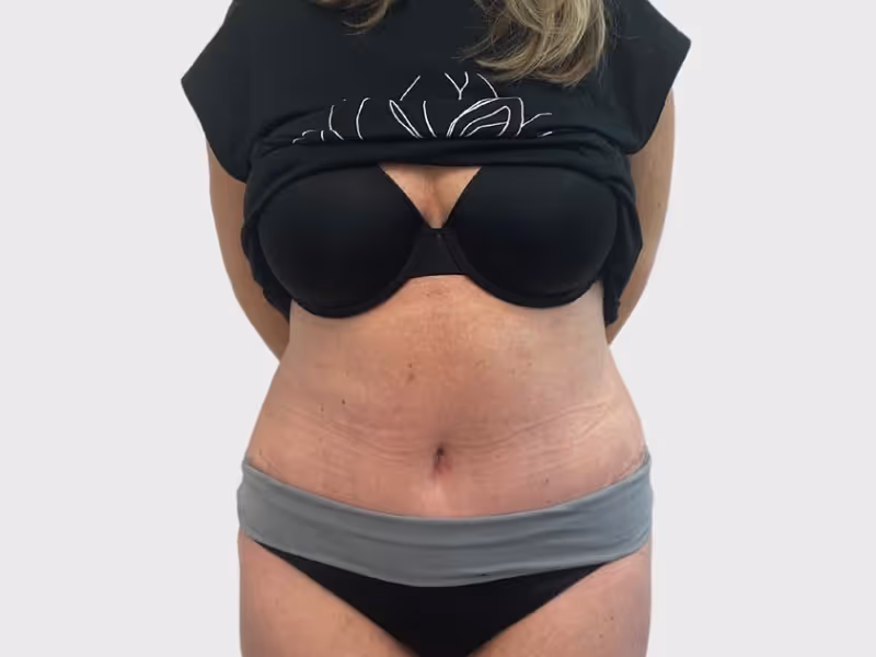 Abdominoplasty Case 7 after view