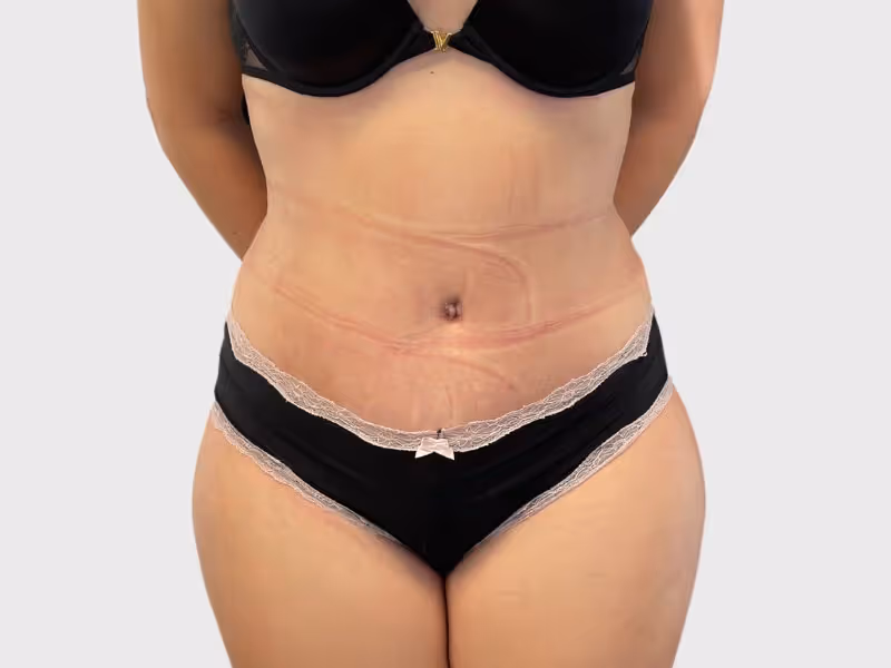 Abdominoplasty Case 6 after view