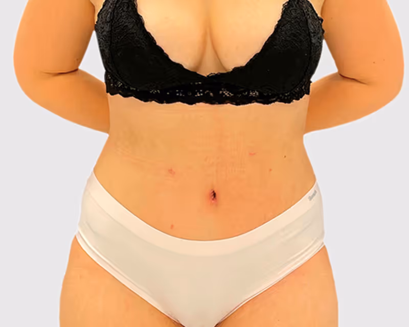 Abdominoplasty Case 8 after view