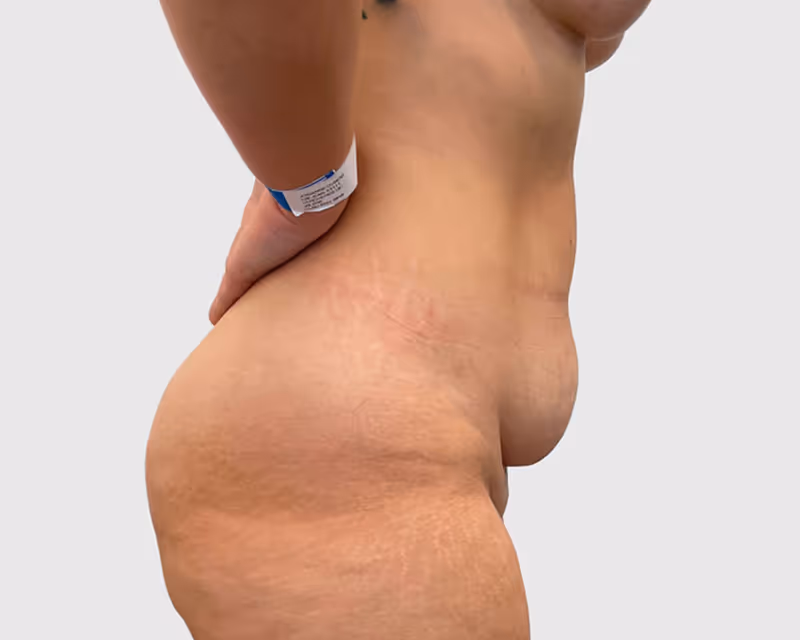 Abdominoplasty Case 8 before view