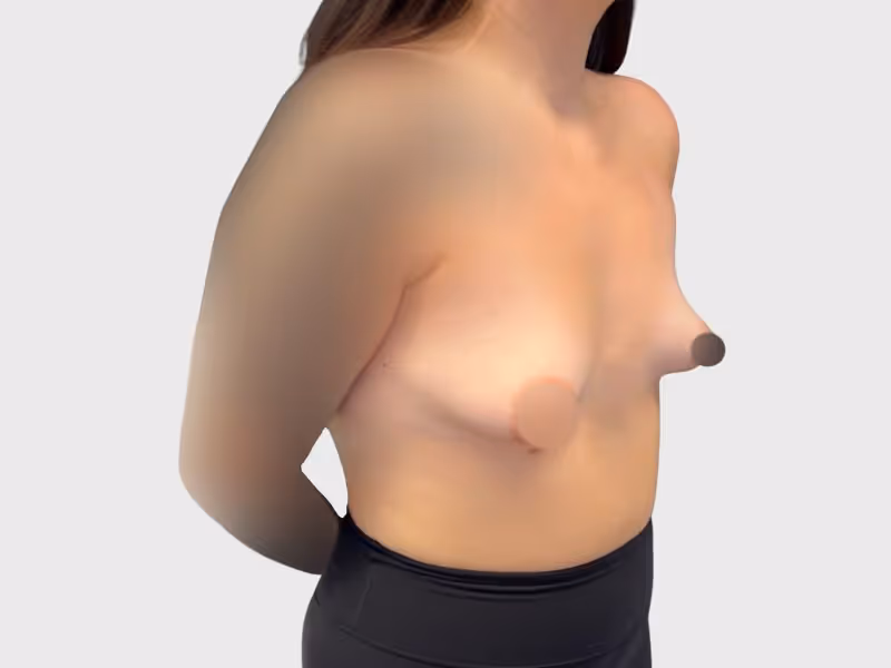 Breast Lift Case 2 before view