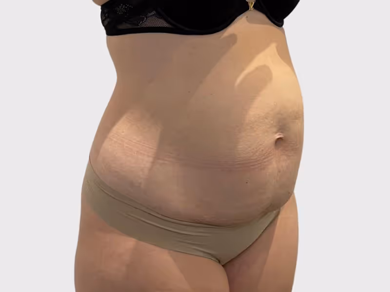 Abdominoplasty Case 6 before view