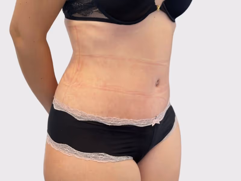 Abdominoplasty Case 6 after view