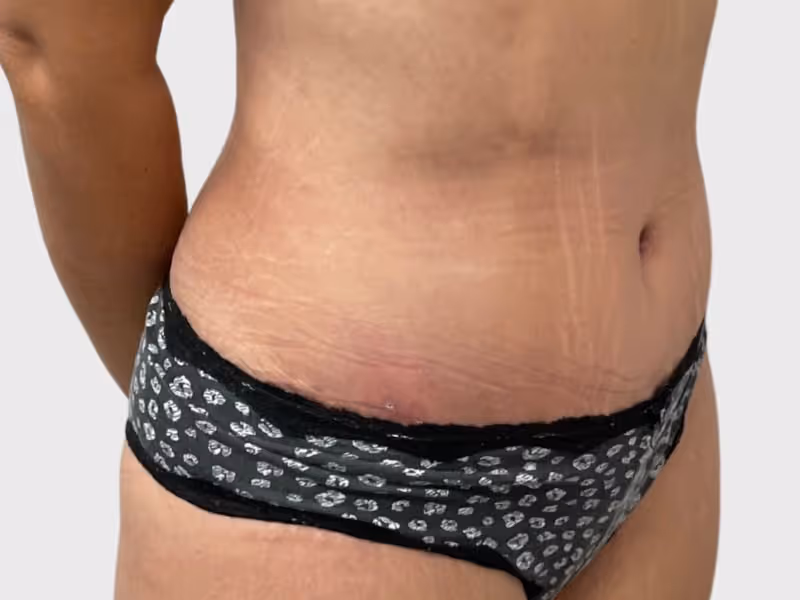 Abdominoplasty Case 3 after view