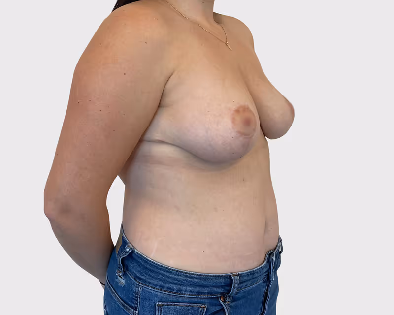 Breast Lift Case 4 after view