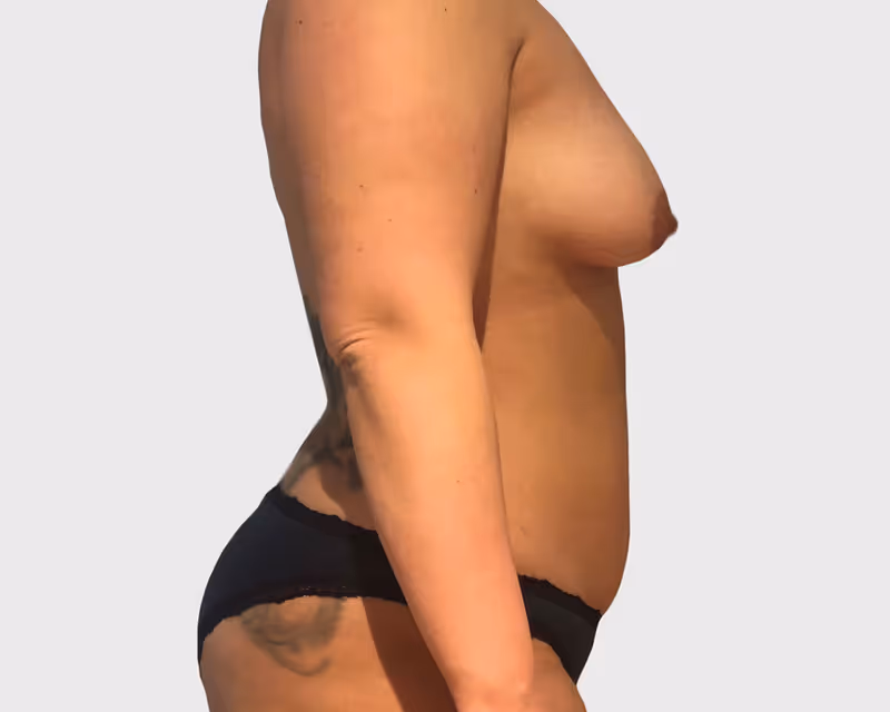 Breast Lift Case 3 before view