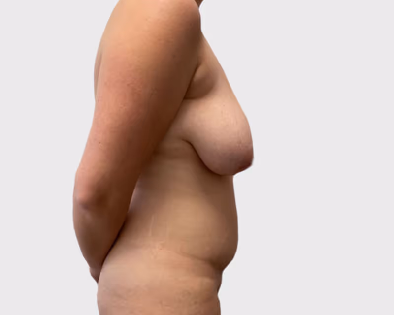 Breast Lift Case 4 before view