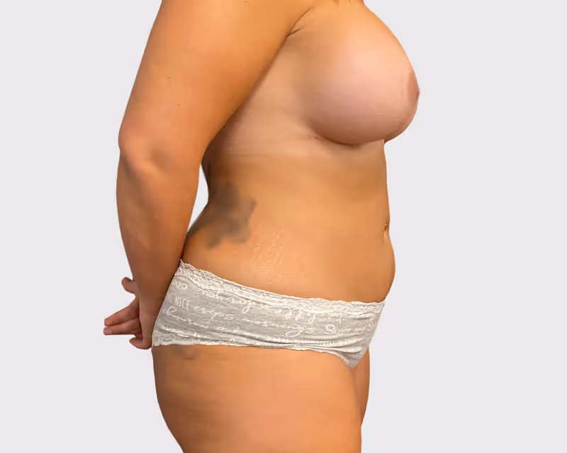Breast Lift Case 3 after view